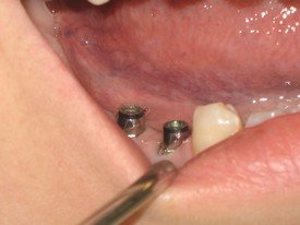 Implant-Crowns gallery